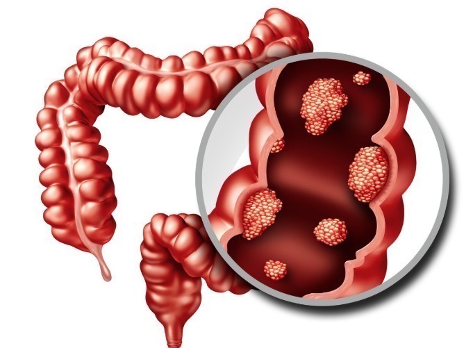 病理|大肠癌早、中、晚期是如何划分的?关键是根据这个信息