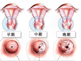下體|宮頸癌若近身，可能會有1個明顯表現，早知道，早治療