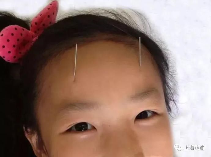 單純性近視|青少年近視？這份中醫指南收好