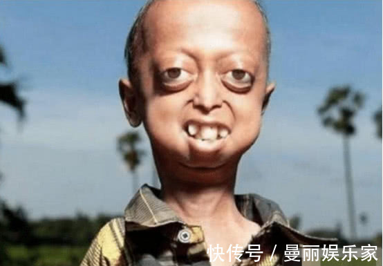 鸡胸|为什么患上“鸡胸”的宝宝越来越多做父母的责任很大啊