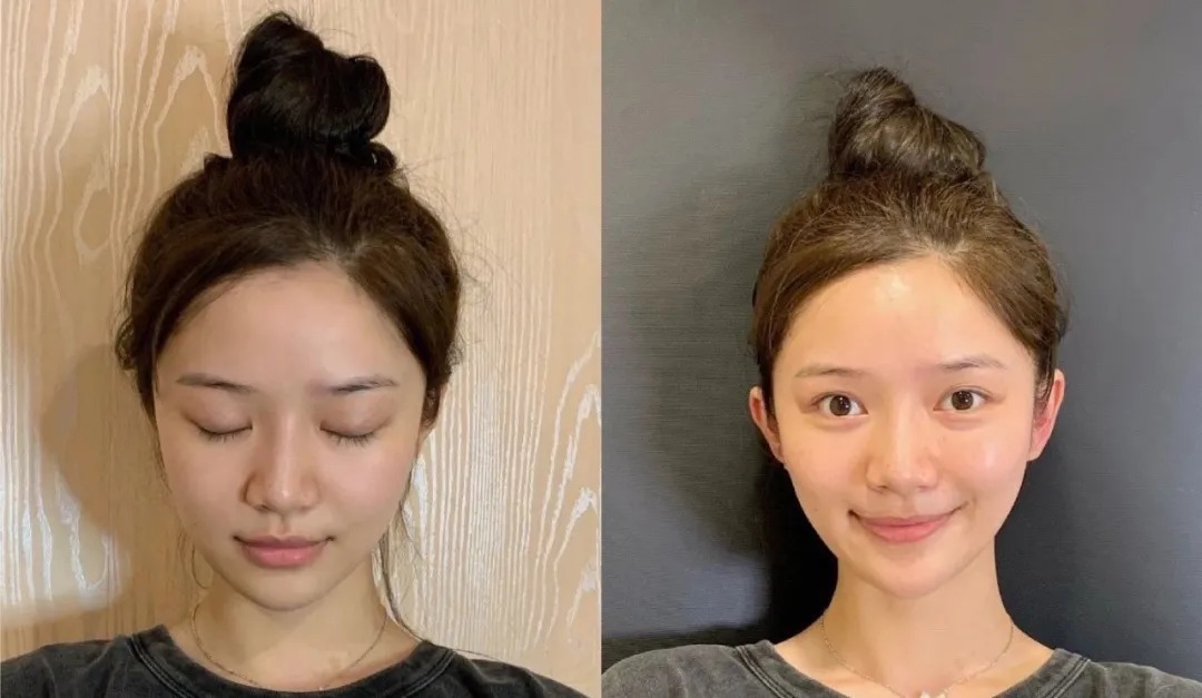 手术|又一个被“自残式整容”手术毁掉的中国女孩,好可怕...