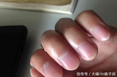 肝脏|肝癌“来势汹汹”?手指出现一“异常”,肝脏已在悄悄“癌变”