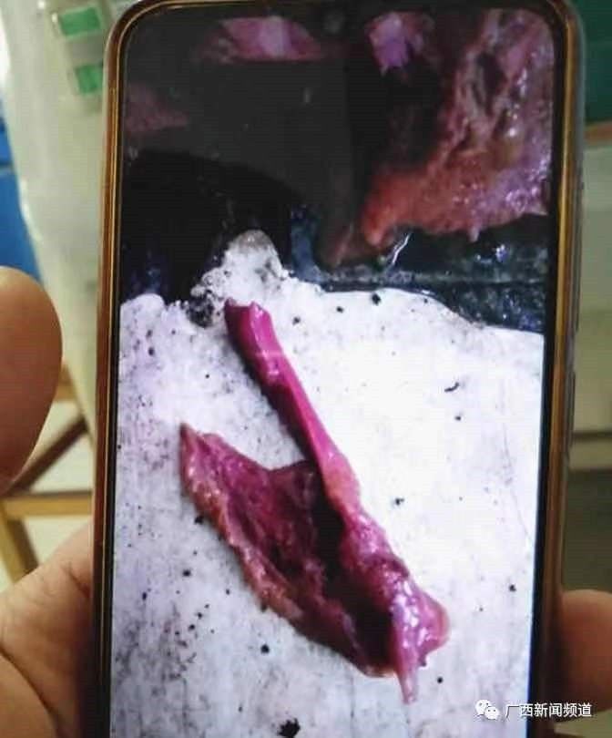 5人食用野生菌中毒送医！中毒者事后回忆：吃起来又脆又甜