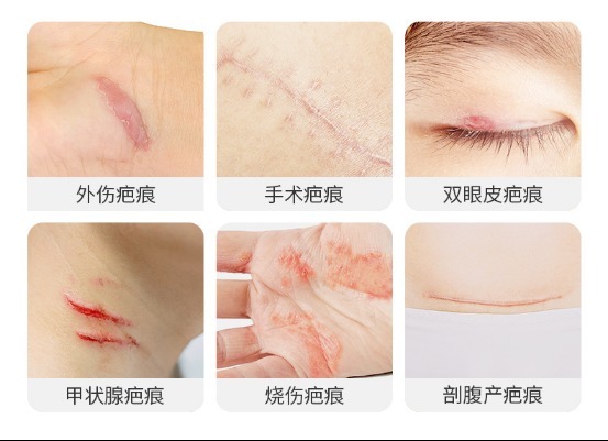 欣奕除疤美容：焕发新生的秘密武器