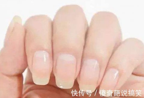 健康|指甲上没有月牙就代表不健康?不完全正确!