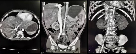 置针|做增强CT，为什么留置针的位置那么重要