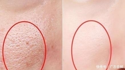 抿紧下巴后突起的“白疙瘩”，千万要注意，这是螨虫的真身吗？