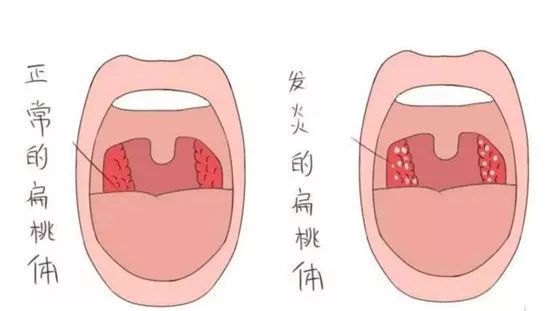 有一种口臭的原因叫扁桃体结石 快资讯