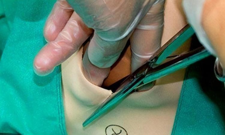 侧切|妈妈关于侧切的“五连问”,一步一步来解答,先马后看