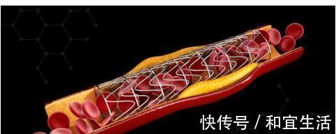 心脏病|最重的心脏病是哪一种?竟然会瞬间要人命?原来心脏病这么分