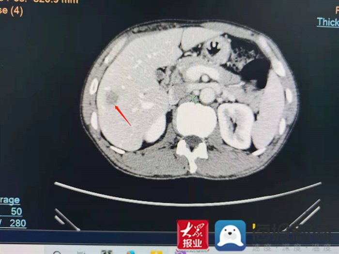 患者|“小针治大病”！泰安市中医医院为直肠癌术后患者成功实施肝脏肿瘤微波消融术
