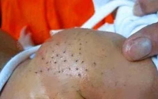 生病|宝宝身上长“小黑虫”,妈妈用心一颗颗拔掉,不料孩子被送去抢救