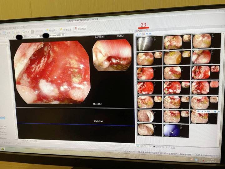 腺瘤息肉|毫无症状镜检出结肠腺癌,40岁以上人群尤其需要注意