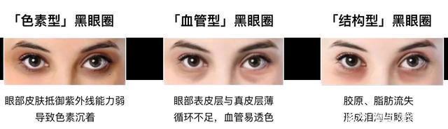 熬夜党也能不怕黑眼圈两个步骤教你拥有神采双眸!