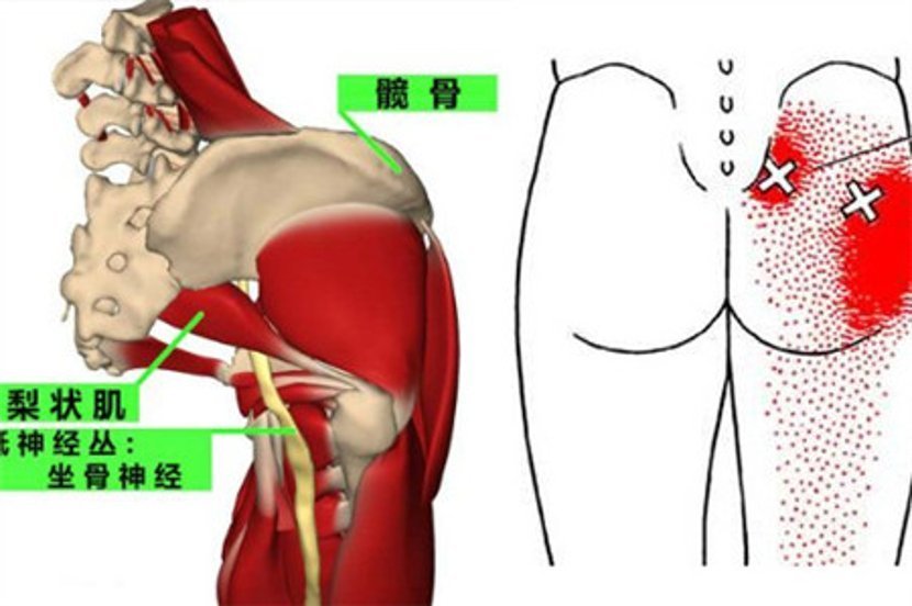  腿疼|腿疼腰痛的你可能冤枉椎间盘了很可能是腚上的问题