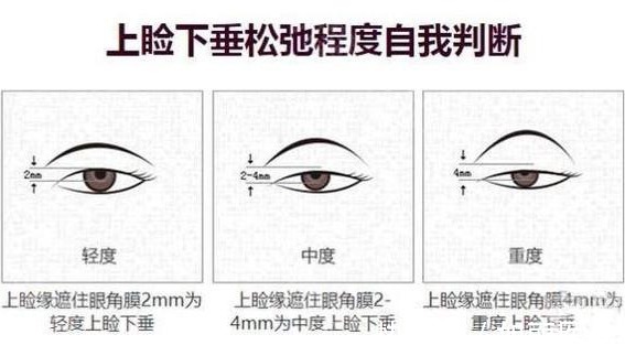 并发症 上睑下垂术后多久恢复自然？其实这1点才更该重视