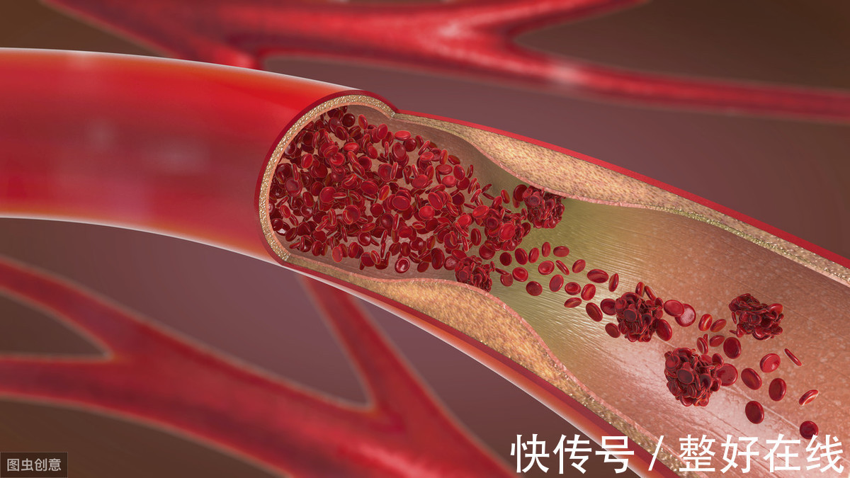 头晕|头晕乏力一定是累的吗?小心高血脂悄悄找上门!调节血脂做好3点