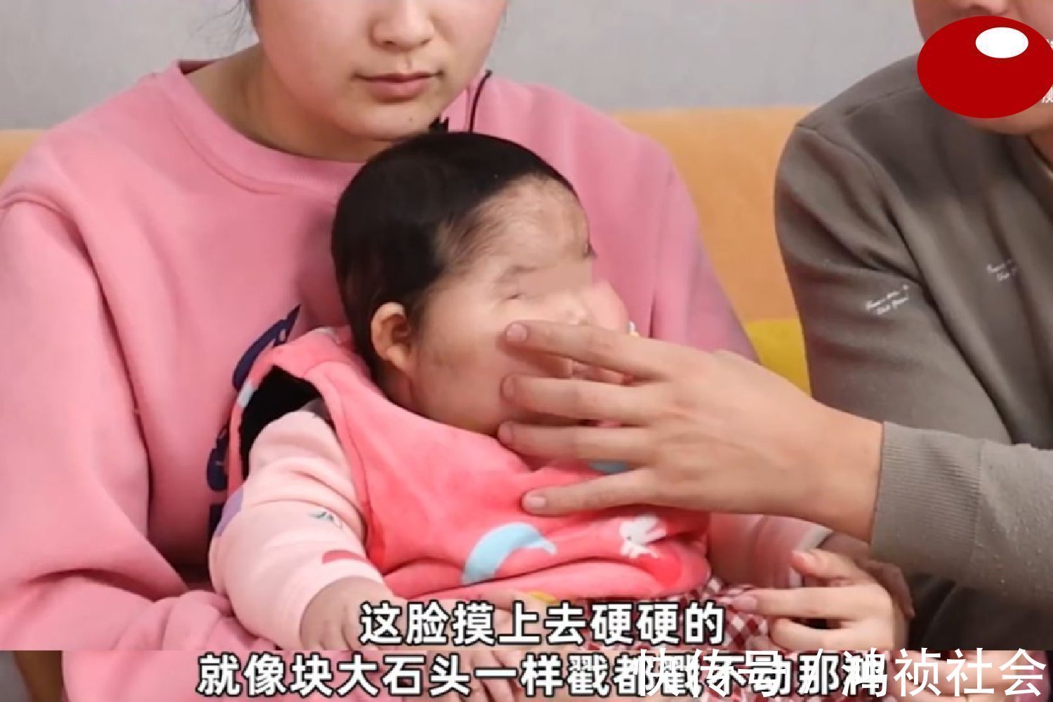 氯倍他索丙酸酯|“大头娃娃”再现,抑菌霜激素超标,致5个月女婴疯狂长胖长毛