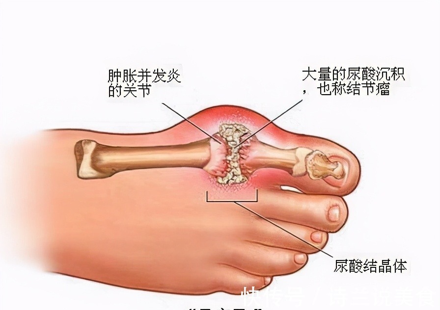 黄麦|脚是身体的“放大镜”，出现3种情况，可能是健康发出“预警”！