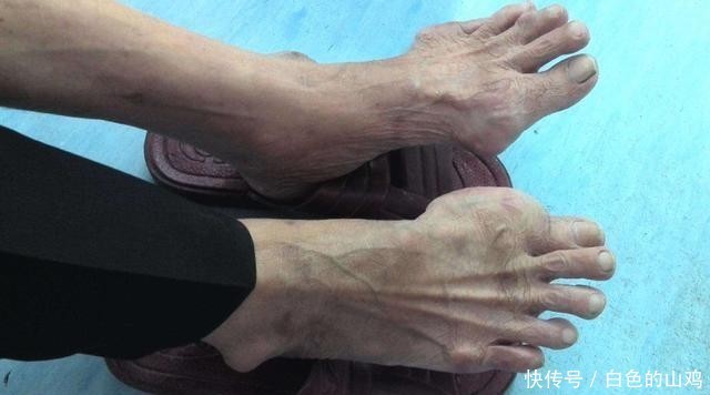 身体|身体出现4个表现,可能是尿酸高了,控尿酸,建议“3多2少”