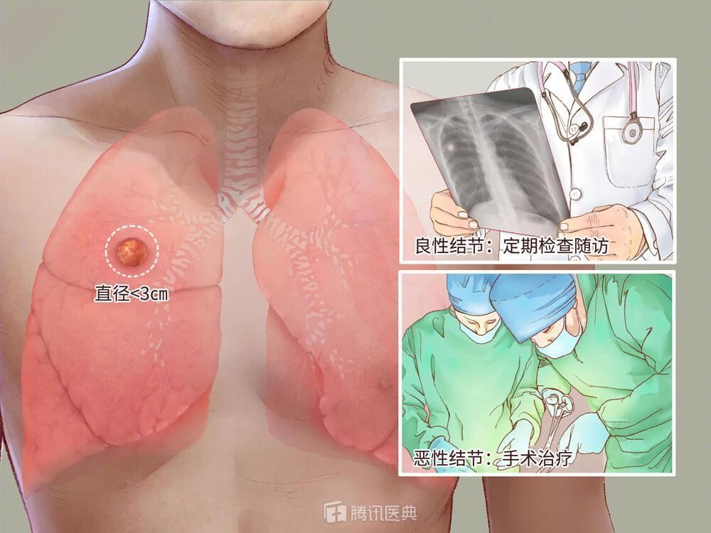 磨玻璃结节|体检查出肺结节,是癌吗?医生:害怕肺癌,先看这2件事做对了没