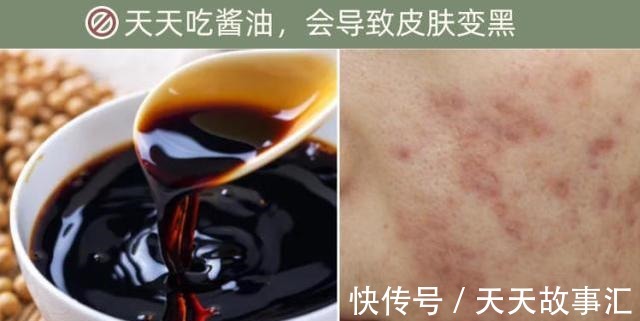 酱油 天天吃酱油,会导致皮肤变黑吗美白护肤有哪些误区!