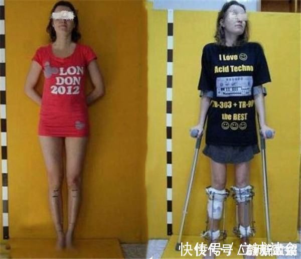 禾苗|男孩为当飞行员花16万断骨增高,多年后,因“长高”毁掉人生