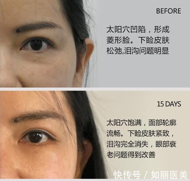 人中 人中长=很显老?“人中缩短手术”可以做吗?