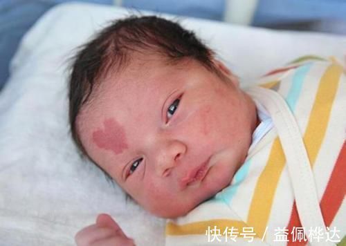 孕期|胎记是怎么来的?产科大夫:天生的除外,孕期这3种行为尽量避开