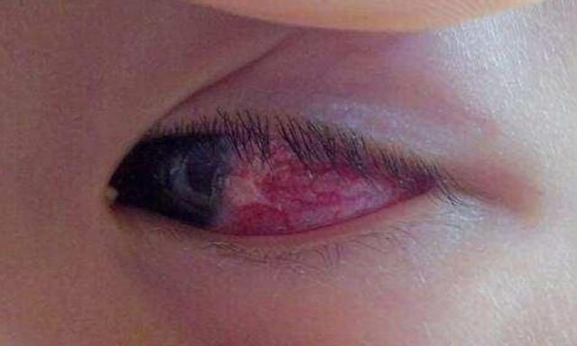 宝宝双眼近乎失明，都是因为家长的忽视，父母必看