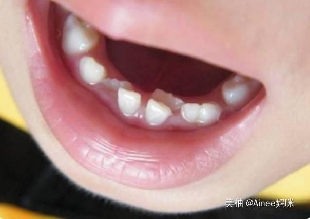 孩子乳牙整齐漂亮，换牙后却越来越“歪”可能是这几点没做好