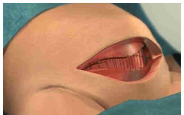 刀口|剖腹产真有想得那么简单吗？看看手术所需的“工具”，真为母则刚