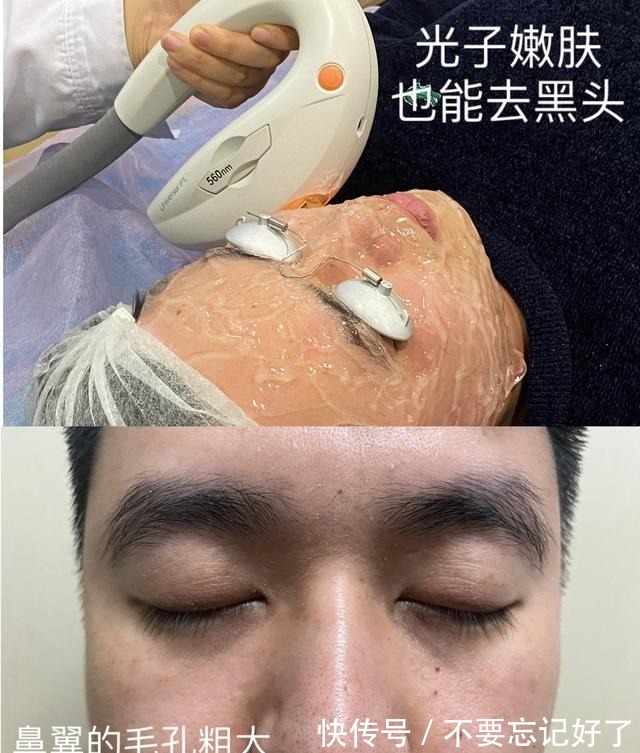 弊端 用过都说好的光子嫩肤也有弊端!