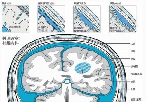  脑出血|脑出血也是有迹可循的，身体出现这8个表现，那你就需要警惕了！