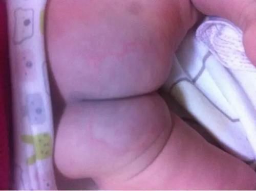 纸尿裤|七个月宝宝尿路感染住院，儿科医生：都是妈妈不负责任，惹的祸