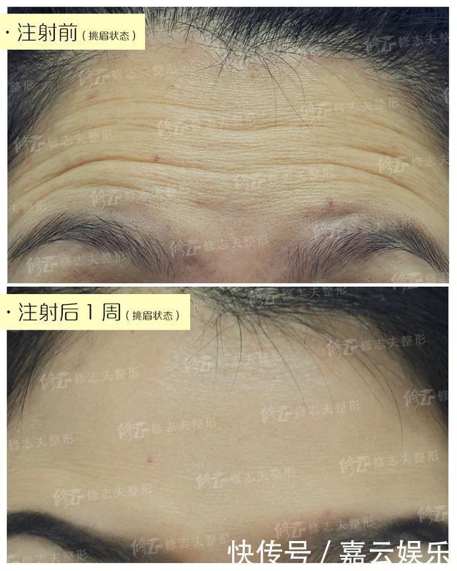 收敛毛孔,除了光子嫩肤,这两种方法也很出色