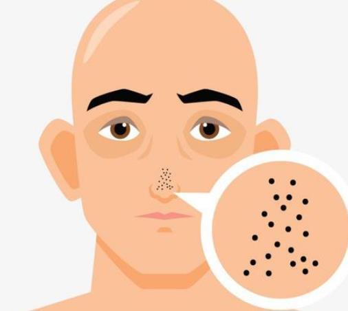 鼻子上挤出的,白色固状是什么?是螨虫分泌物吗?别挤小心败血症