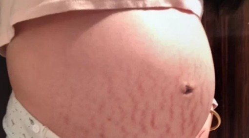 精华乳|生个孩子“肚皮开花”,孕期做好掌握这3点,妊娠纹离你远远的