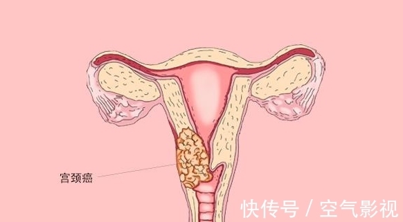 分泌物|48岁女老板，宫颈病变2级转阴，HPV消失了，全因做好一事