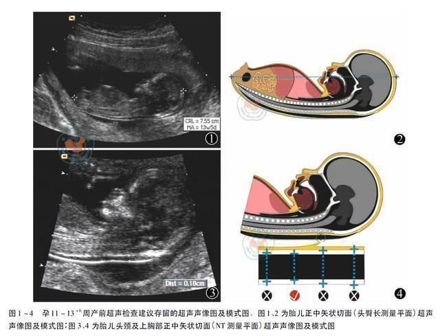 畸形|四维彩超显示胎儿双手握拳,孩子生下来竟然没右臂,母亲伤心欲绝