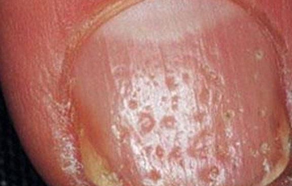 检查|指甲如果长成5种样子，说明你的身体状况不是太好，需要检查了