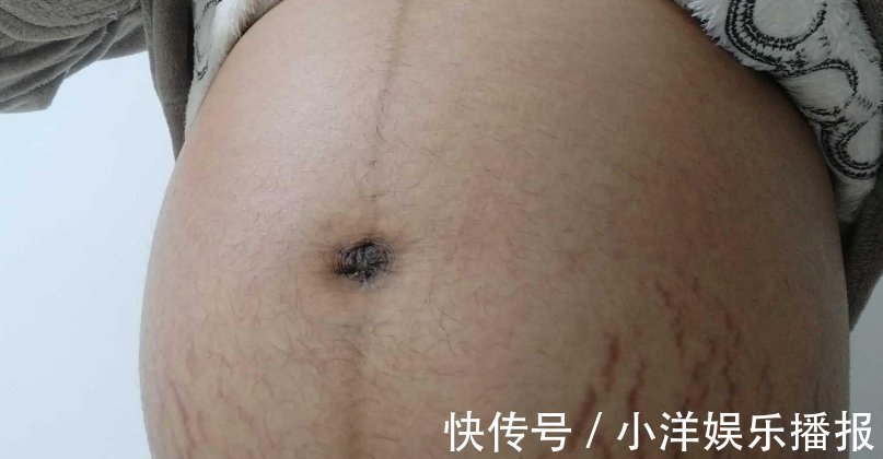 妊娠纹|怀孕7个月的孕妈每天抹油,但还是长了妊娠纹,医生的一句话扎心了