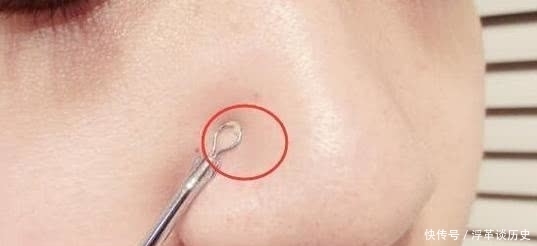 挤出|女生鼻子上能挤出“毛毛虫”?教你3个小妙招,远离“草莓鼻”!