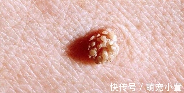 上门|90后情侣感染hpv,医生提醒:男女身上2处“长痘”,或是hpv找上门