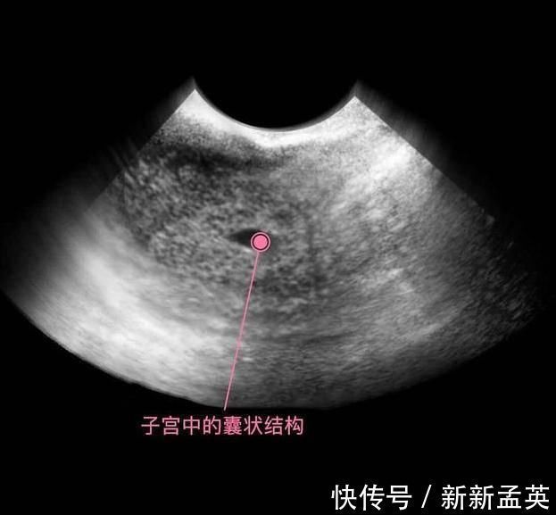 胚胎|胎儿从卵泡到性别形成,17张图片清晰诠释,男宝女宝看得很清楚