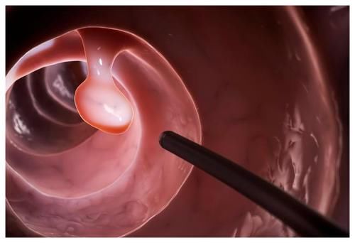 检查|为啥要做肠镜检查？在肠镜检查中，又有哪些事项要注意？