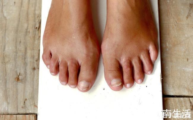 静脉|体内有血栓，脚知道脚上若有4种反应，小心血管随时爆发