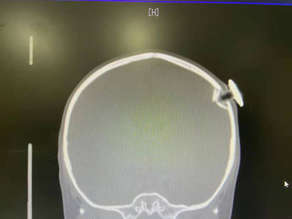 脑膜|家中意外跌倒，3岁女童被“星星”磁力钉撞碎颅骨、刺破脑膜