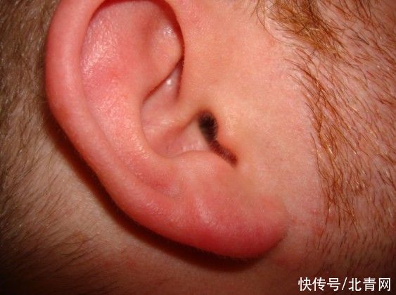 血管性头痛|老人突发耳鸣莫大意，警惕是心梗先兆