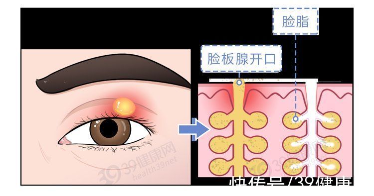 外麦粒肿|长了麦粒肿，怎么治疗好得快？一定要开刀吗？这几件事要记住